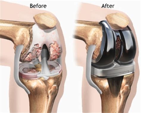 knee cap replacement surgery.